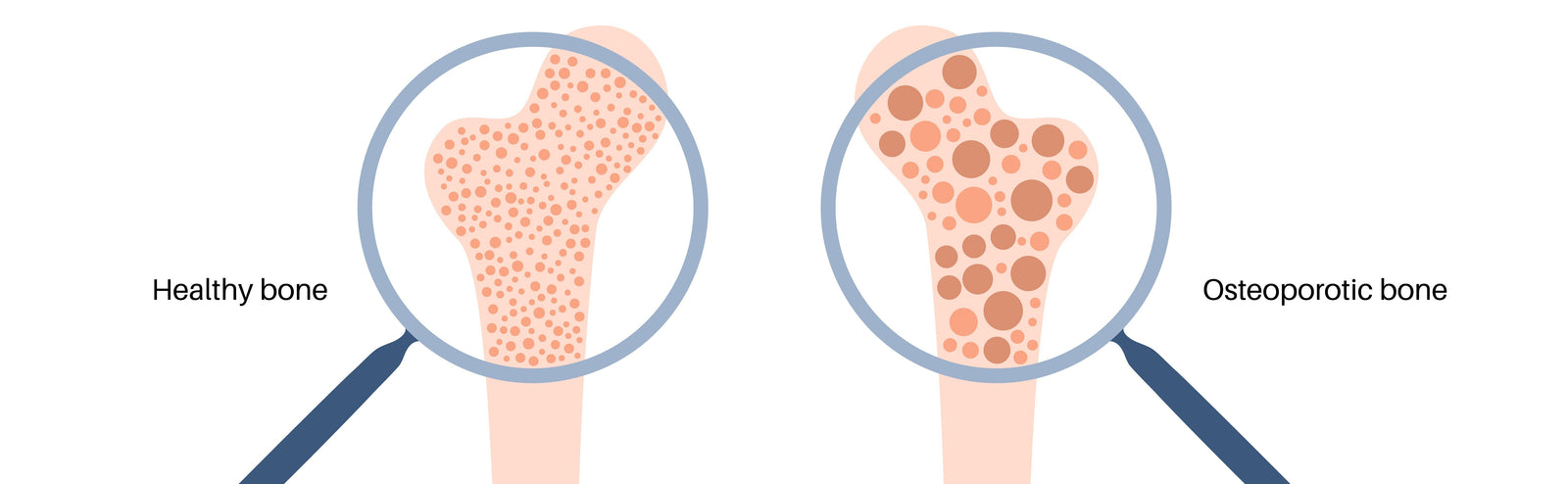 Are Bone Density and Brain Aging Connected?