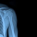 X-ray,Images,Shoulder,Joint,To,See,Injuries,Of,Tendons,And